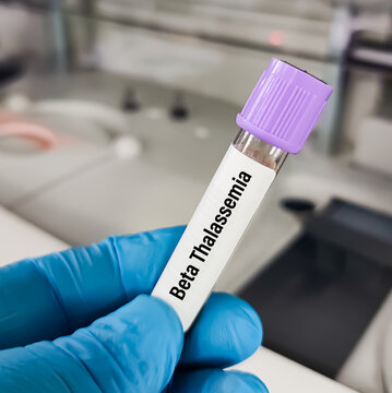 Blood sample for Electrophoresis test. Diagnosis of Thalassemia (alpha or beta)