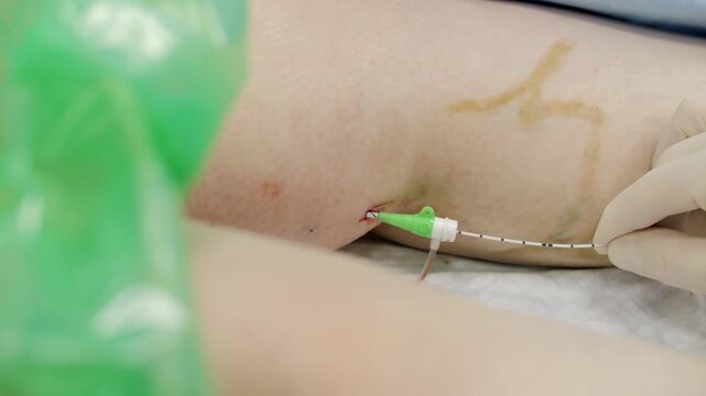 Laser catheter inserted for vein removal procedure
