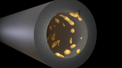 Biofilm accumulation inside tube. Clog in pipe. Atherosclerosis. Arterial blockage with plaque, cholesterol, debris buildup. 3d render illustration. 