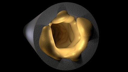 Biofilm accumulation inside tube. Clog in pipe. Atherosclerosis. Arterial blockage with plaque, cholesterol, debris buildup. 3d render illustration. 
