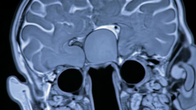 Ultra-sharp volumetric video of human brain & head, coronal view, scrolling MRI-like scan. Reveals cerebrum, cerebellum, brain stem, nasal cavity with internal blue/white glow on black. Clinical