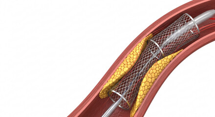 Obraz premium Coronary Stent Opening Blocked Artery — 3D Medical Illustration