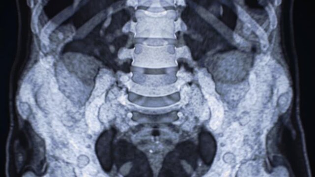 Coronal CT Scan of the Pelvis and Lumbar Spine Showing Bony Anatomy
