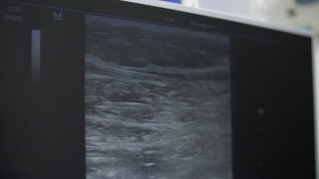 Ultrasound showing laser passing through vein during treatment