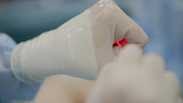 Doctor using laser fiber during endovenous vein treatment