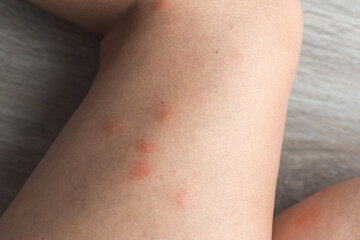 Close-up of a person s leg with multiple red mosquito bites and irritated skin, showing itching and allergic reaction, symbolizing discomfort, summer insect bites, and dermatological care