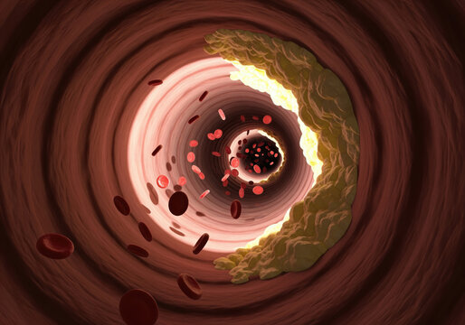 Cross-Section of Healthy and Diseased Artery