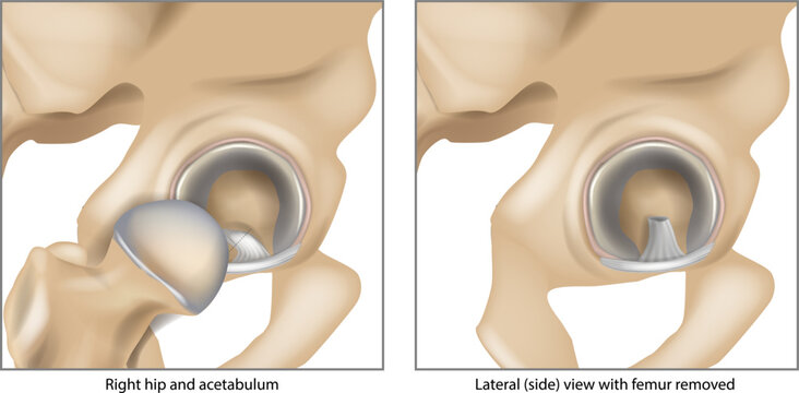 Anatomy of the right hip joint and acetabulum showing the acetabular labrum and ligamentum teres. Femoral head removed on right. arthroscopic ligamentum teres debridement, resection