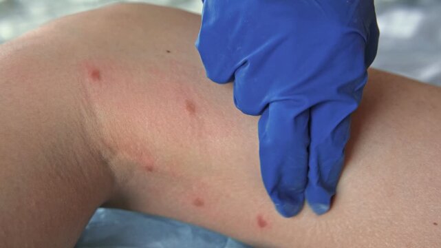 Doctor examining teen girl with bodily red rash. Allergy closeup. Teenager scratches eruption. Nurse applies special cream to atopic skin. Dermatitis, irritation, hive. Pruritus. Mosquito, flea bites