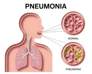 Obraz premium Pneumonia concept background. Realistic illustration of pneumonia vector concept background for web design