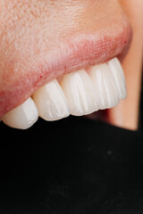 Macro side view of glossy porcelain veneers and natural lips on black background