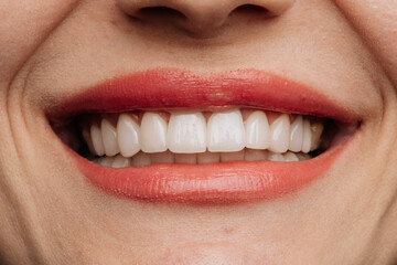 Obraz premium Closeup smile with white porcelain veneers and coral lipstick dental aesthetic beauty