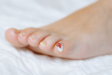 Little finger with hydrogen peroxide on a woman's foot.