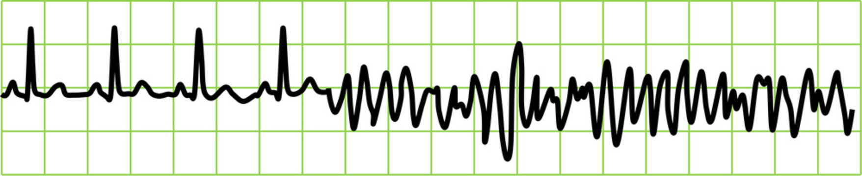 心室細動のグラフィック素材イラスト