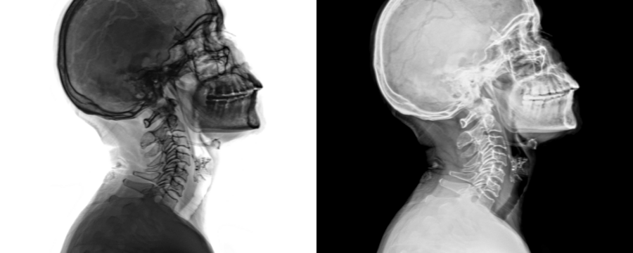 Lateral Projection X-Ray Image of the Neck Showing Cervical Vertebrae and Soft Tissues for Diagnostic Evaluation Isolated on Transparent Background