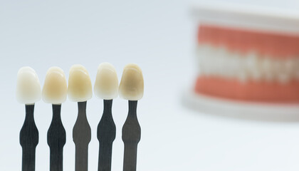 Tooth color comparison with dental model in background