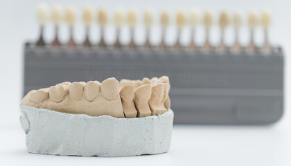 Dental model with tooth shade guide in background