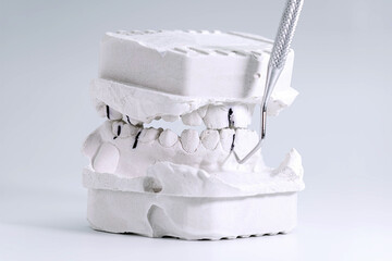 Dental plaster model with marked occlusion points