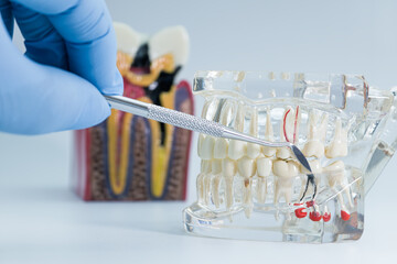 dental root canal model being examined with a dental tool, used for education, training, or patient explanation.