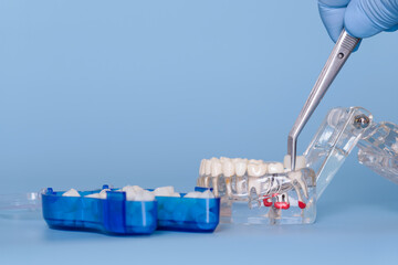 Dental prosthetic tooth placement on jaw model