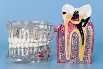 Dental jaw model and tooth decay anatomy model
