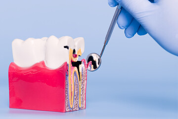 dental model displaying tooth structure and cavity, examined with a dental mirror by a gloved hand.