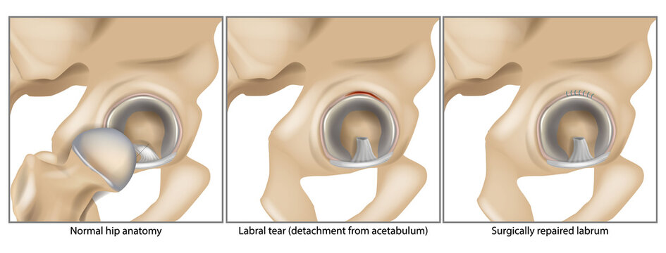 Detailed medical illustration showing the stages of hip labral injury and repair. Labrum reattached to acetabulum, Surgically repaired labrum, Labral tear