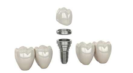 Dental implant with crown and bridge isolated on transparent background