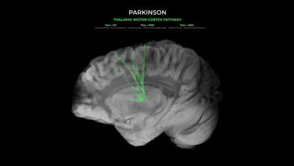 Parkinson Dopamine Loss Thalamo–Motor Cortex Pathway Disruption Sagittal View