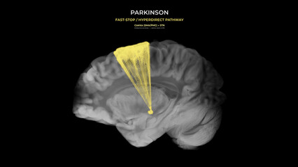Parkinson Dopamine Loss Hyperdirect Neural Pathway Disruption Sagittal View