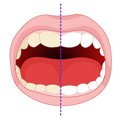 Teeth whitening  before after.  Home and office type tooth bleaching. Vector illustration