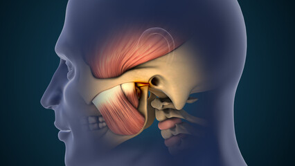TMJ Disorder Causing Jaw Pain and Inflammation