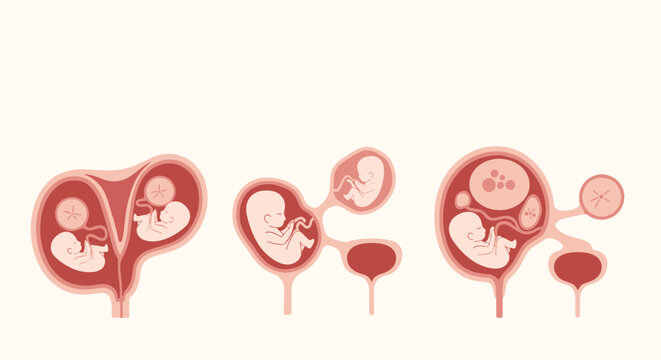 Medical illustrations depicting different types of twin pregnancies, including monochorionic-diamniotic and complex cases like vanishing twin syndrome.