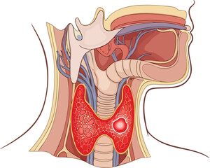 Detailed illustration of a cancerous thyroid gland, highlighting a visible tumor, crucial for medical education and research into thyroid cancer treatments