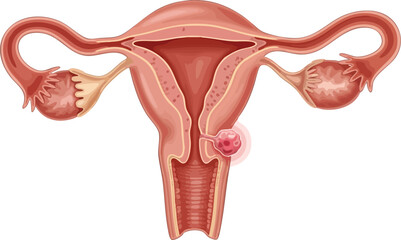 Uterine fibroid, a common non-cancerous growth, may be mistaken for early signs of uterine cancer