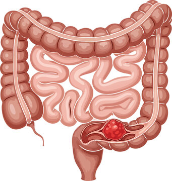 Illustration of a cancerous polyp within the colon, representing the dangers of colon cancer and the importance of early detection
