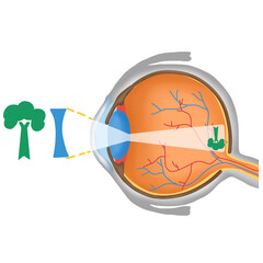 Myopia Correction Diagram, Concave Lens Focusing Light on Retina for Clear Vision