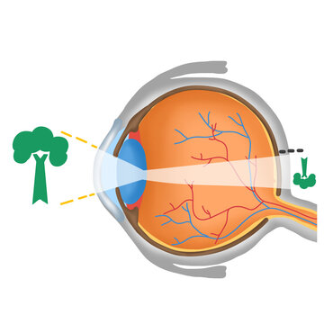 Hyperopia or Farsightedness, Eye Vision Diagram, Focus Behind Retina