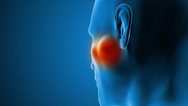 Human Parotid Gland Neoplastic Growth
