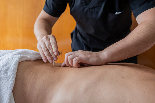 Acupuncture treatment on back for holistic Chinese medicine wellness