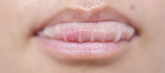 Mouth Ulcer Sore or Aphthous Stomatitis. Oral Health and Medical concepts