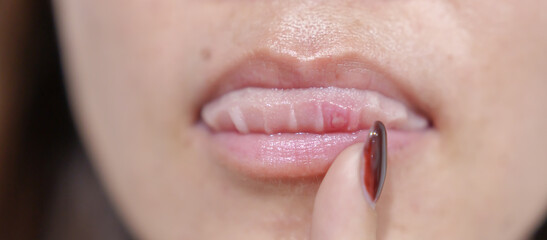 Mouth Ulcer Sore or Aphthous Stomatitis. Oral Health and Medical concepts