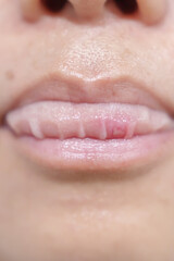 Mouth Ulcer Sore or Aphthous Stomatitis. Oral Health and Medical concepts