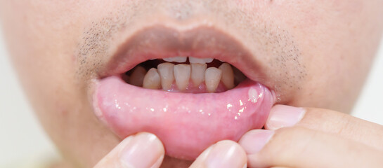 Mouth Ulcer Sore or Aphthous Stomatitis. Oral Health and Medical concepts