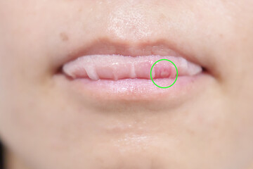 Mouth Ulcer Sore or Aphthous Stomatitis. Oral Health and Medical concepts