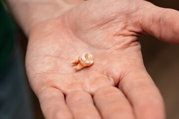 Human's tooth torn out after dentist surgery laying on the palm of the hand