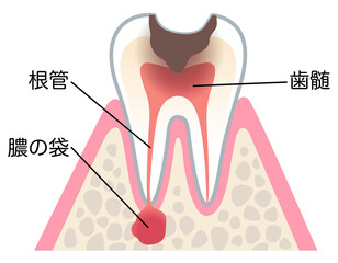 むし歯が進行し、歯の根にある神経に膿がたまった歯の断面図　根管治療