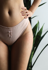 Visible stretch marks on Woman hips. Woman with natural body contours and stretch marks on her thighs. Concept of body positivity.