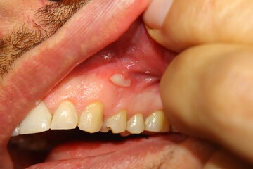 Close-up painful gum ulcer shows a white irritated center and a surrounding red inflamed area on the inner gum. Ideal for dental medicine, oral care education, symptom and healthcare awareness content