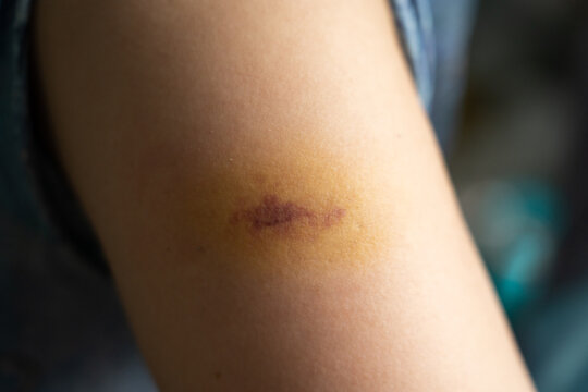 Bruise injury found on the female arm